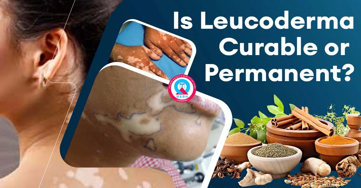 is-leucoderma-curable-or-permanent